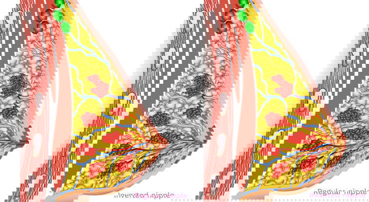 Female breast diagram showing regular nipple and inverted nipple.